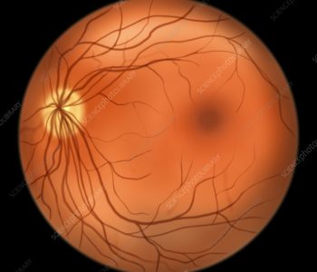 Normal retina, computer illustration of an ophthalmoscope image. The retina is the light-sensitive membrane that lines the back of the eye. Blood vessels (red) radiate out from the optic disc (yellow, left). The optic disc is the area where the optic nerve and blood vessels enter the eye. Due to this, it has no light- sensitive cells, and is the cause of the blind spot. The dark red area at right centre is the macula. This is the region of the retina with the highest concentration of light-sensitive cells, and is responsible for the sharp vision at the centre of the visual field.