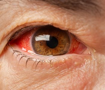 Close up of one annoyed red blood eye of mature adult women affected by conjunctivitis or after flu, cold or allergy